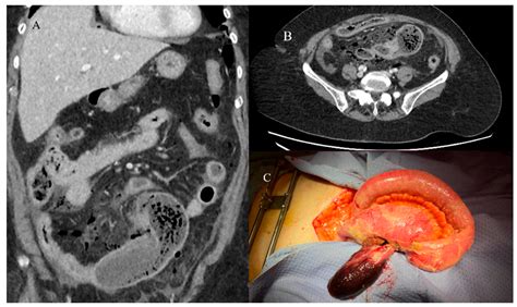The Many Faces of Intestinal Tumors in Adults, Including the Primary ...