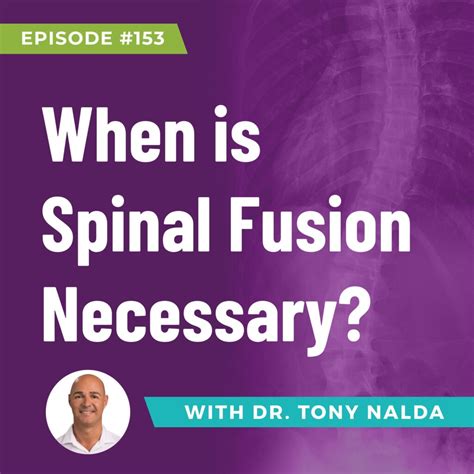 Episode 153: When is Spinal Fusion Necessary?