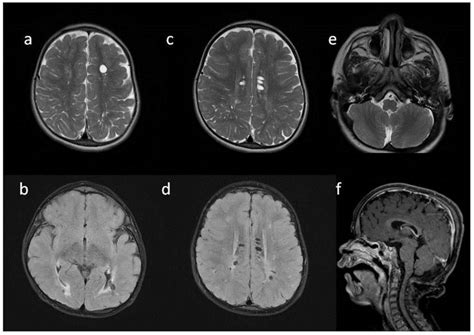 Mucopolysaccharidosis Type 1 among Children—Neuroradiological ...