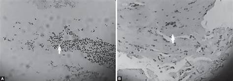 Simple Immunocytochemistry from Menstrual Blood in Diagnosis of ...