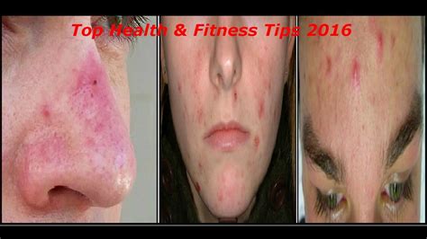 home remedies for zits on nose