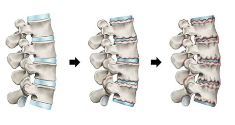 Ankylosing Spondylitis Depicted By 3D Medical Animation, 54% OFF