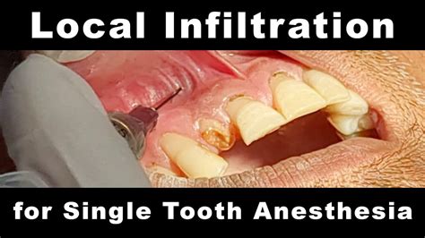 Infiltration Anesthesia 的图像结果