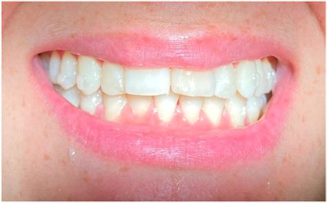 Clear Aligners and Smart Eye Tracking Technology as a New Communication ...