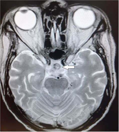 Pituitary Gland Mri Axial