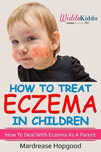 How To Treat Eczema In Children: Dealing With Eczema as a Parent eBook ...