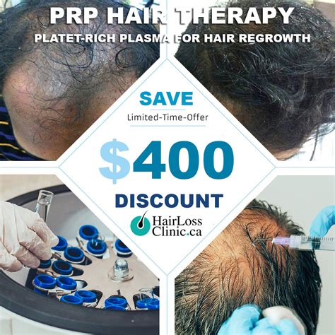 Prp Hair Treatment Lexington Ky at Denise Callaghan blog
