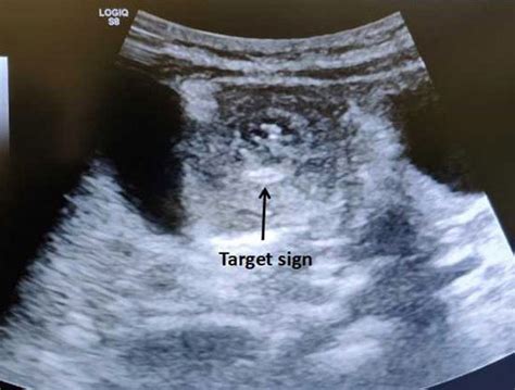Hydrostatic Reduction of Intussusception 的图像结果