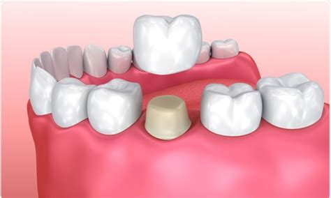 How to Safely Remove Dental Cement from Crowns
