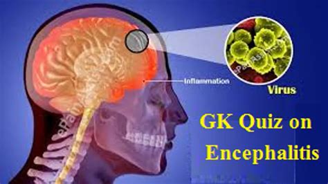 Encephalitis (Chamki Fever): 10 GK Questions and Answers