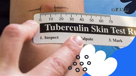Image result for Free Printable TB Test Form