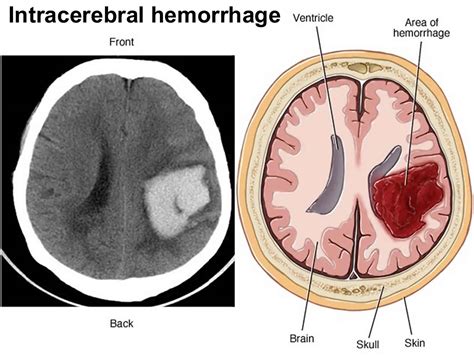 Intracerebral hemorrhage causes, symptoms, diagnosis, treatment & recovery