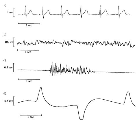 1 sample waveforms: (a) ecg, normal sinus rhythm; (b) eeg,