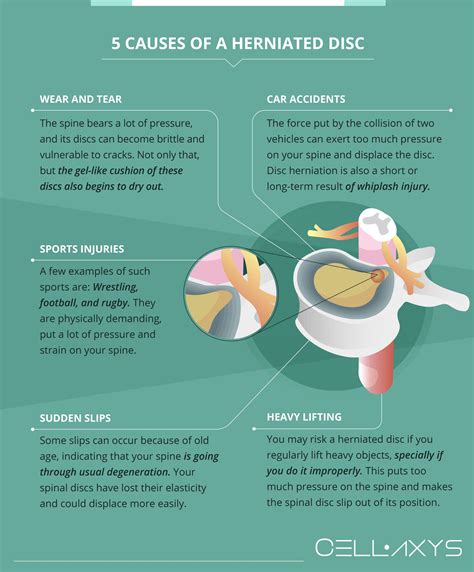 How To Heal A Herniated Disc Naturally - Cellaxys