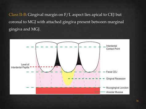 Gingival recession classifications | PPTX