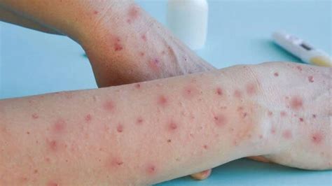 Mpox confirmed in Kerala's Malappuram; alert in district - KERALA ...