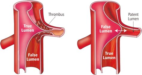 Define Subacute Disease