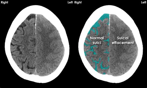Image result for Effect CT Scan
