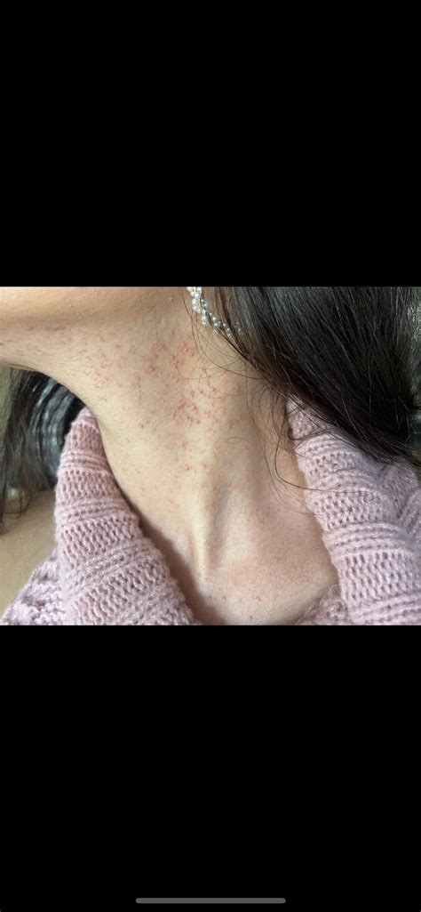 Fungal acne on neck : r/Fungalacne