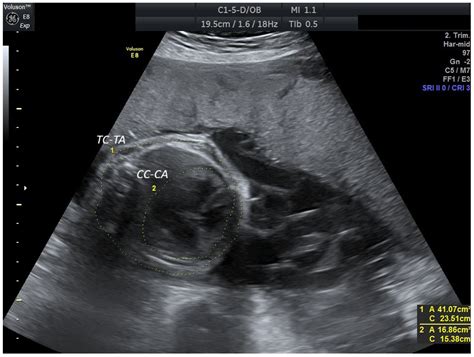 Persistent Right Umbilical Vein: Clinical Case and Literature Review