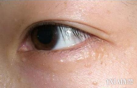 【图】眼睛周边长脂肪粒怎么治疗 3种去除方法介绍(3)_眼睛 脂肪粒_伊秀美容网|yxlady.com