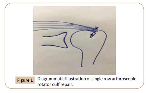 Image result for Single Row Rotator Cuff Repair