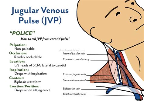 Sketchy Medicine | Jugular venous pressure, Nursing school notes ...
