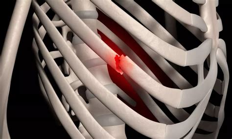 Freezing Pain Away after rib fracture: Cryoneurolysis for Lasting ...