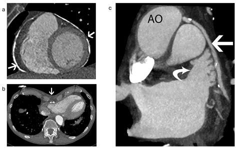 Advancements in 3D Transoesophageal Echocardiography (TOE) and Computed Tomography (CT) for ...