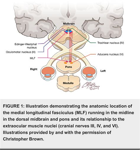 Figure 2 from The Medial Longitudinal Fasciculus and Internuclear ...
