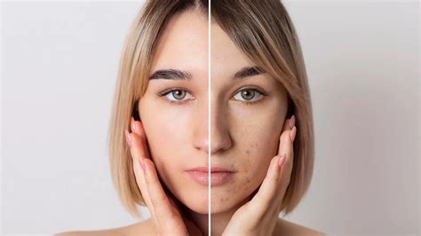 What is the Difference Between Sun Spots & Melasma? | OVO Medi Spa