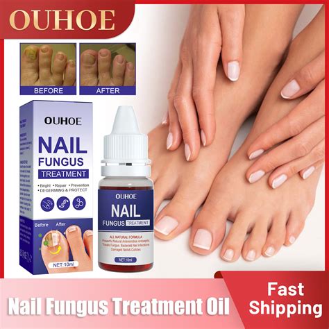 Nail Fungal Treatment Serum Anti Infection Paronychia Onychomycosis Toe Fungus Remover Gel Nail ...