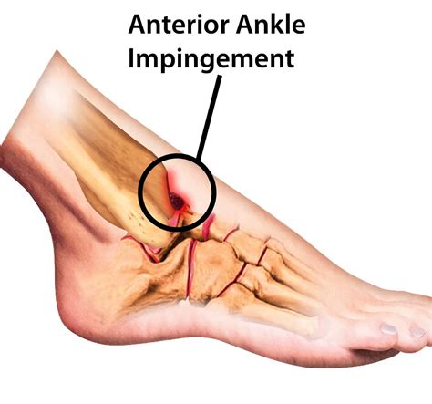 Anterior Ankle Impingement: Causes, Symptoms, Treatment
