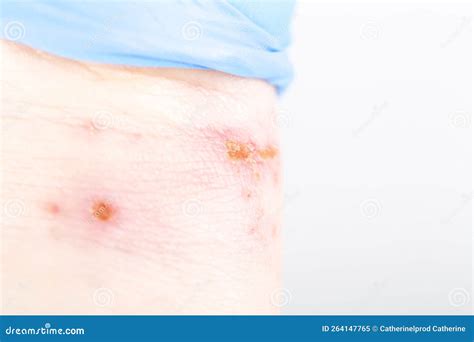 Sulfuric Acid Burns Skin