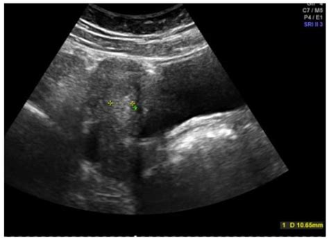 Menstrual Disorders in Adolescence: Diagnostic and Therapeutic Challenges