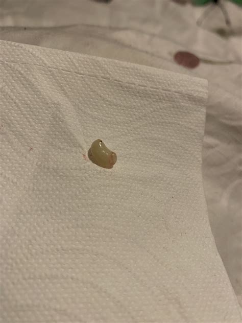 Contents of Bartholin cyst rupture 9/10 Satisfied : r/popping