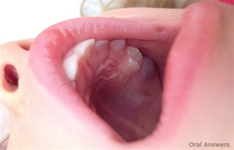 Eruption Cyst: A Purple Blue Bump on Your Baby’s Gums | Oral Answers