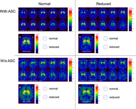 Image result for Dat SPECT Scan