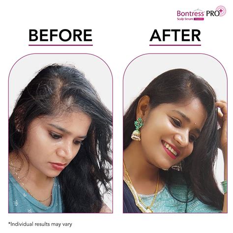 Bontress Pro+ Scalp Serum | Uses, Side Effects, Price | Apollo Pharmacy