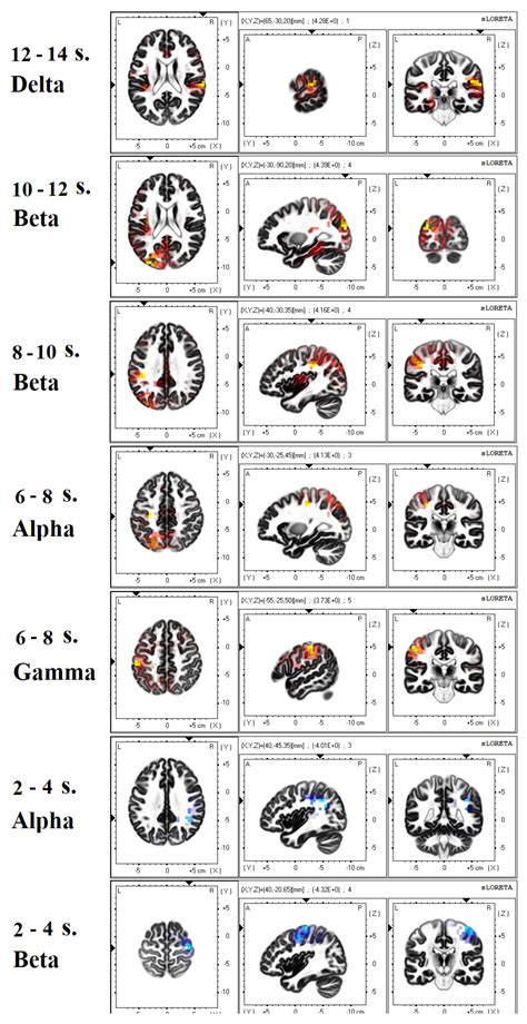 EEG and fMRI Correlates of Insight: A Pilot Study