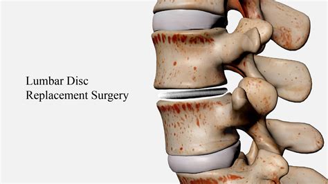 Image result for Disc Surgery