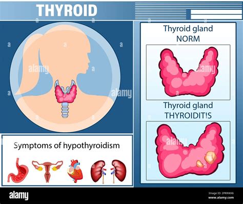 Illustration of thyroid gland and symptoms of hypothyroidism. Medical ...