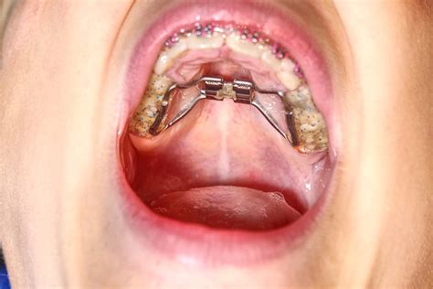 Image result for Crossbite Treatment Options