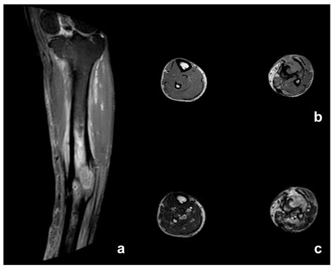 Management of Squamous Cell Carcinoma in Chronic Osteomyelitis: Our ...