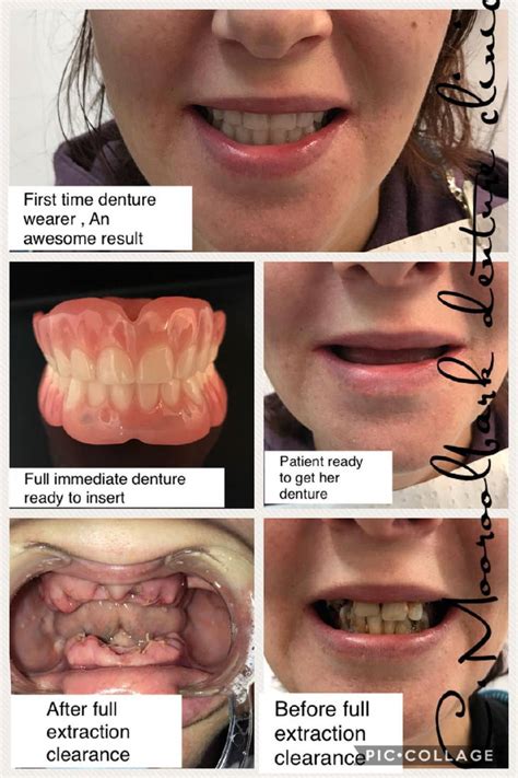 Image result for Immediate Denture Process