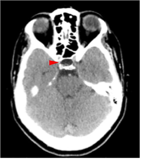 Partial empty sella in a woman with cerebral venous sinus thrombosis: A ...