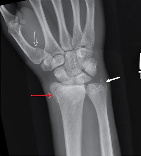 Growing pains: Salter-Harris classification of physeal injuries | Radiology Key