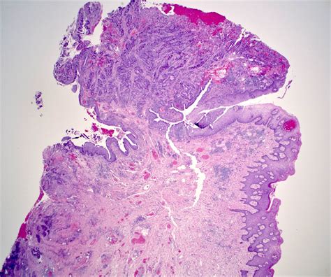 Thrombosed Hemorrhoid Histology