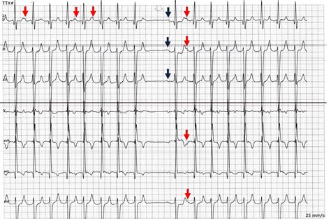 Ectopic Atrial Tachycardia Ecg