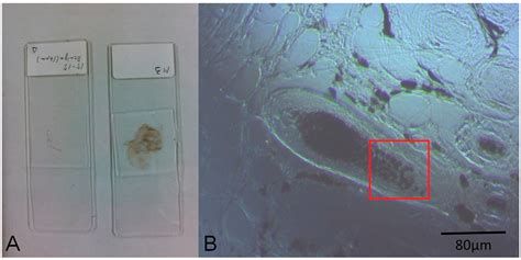 Label-Free Imaging of Melanoma with Confocal Photothermal Microscopy ...